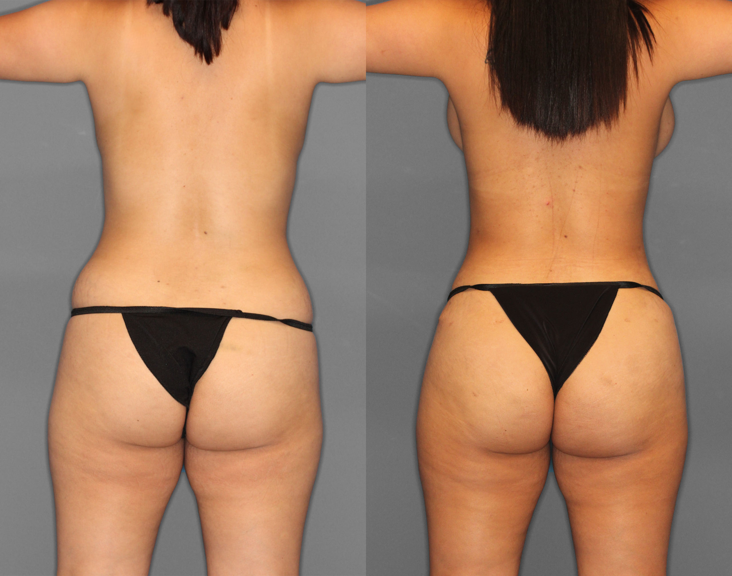 Tummy Tuck Before and After photo by Dr. Abigail Rodriguez in Houston, TX