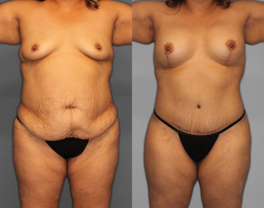 Tummy Tuck Before and After photo by Dr. Abigail Rodriguez in Houston, TX