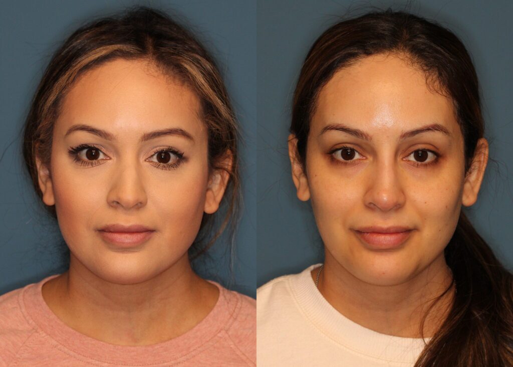 Non Surgical Rhinoplasty Before and After photo by Dr. Abigail Rodriguez in Houston, TX