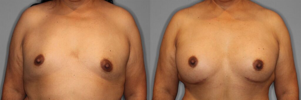 Breast Augmentation Before and After photo by Dr. Abigail Rodriguez in Houston, TX 158735