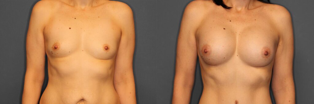 Breast Augmentation Before and After photo by Dr. Abigail Rodriguez in Houston, TX
