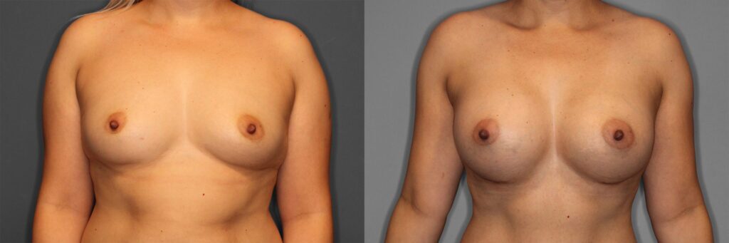 Breast Augmentation Before and After photo by Dr. Abigail Rodriguez in Houston, TX