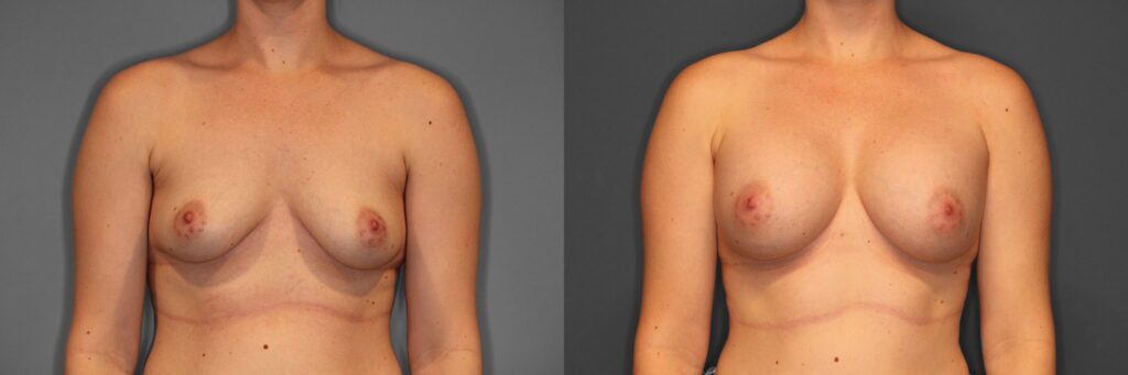 Breast Augmentation Before and After photo by Dr. Abigail Rodriguez in Houston, TX