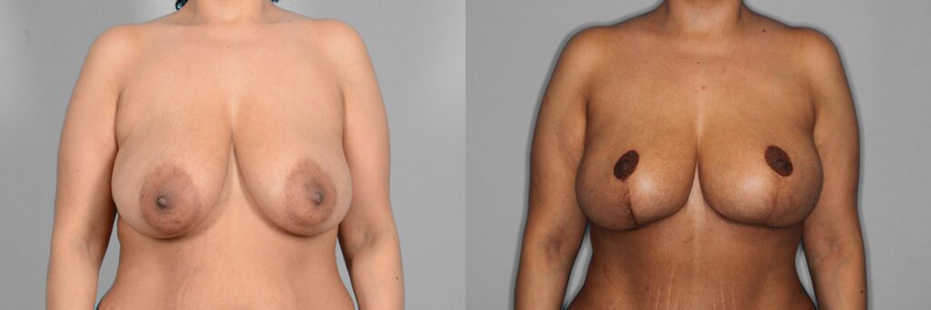 Breast Lift + Augmentation Before and After photo by Dr. Abigail Rodriguez in Houston, TX
