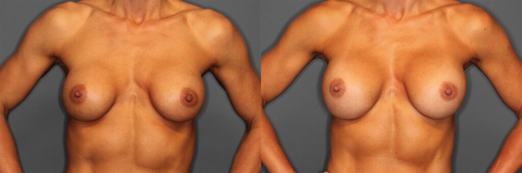 Breast Revision Before and After photo by Dr. Abigail Rodriguez in Houston, TX