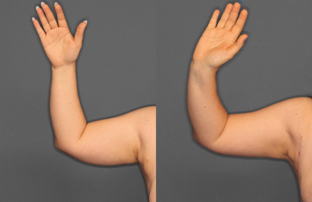 Liposuction Arms Before and After photo by Dr. Abigail Rodriguez in Houston, TX