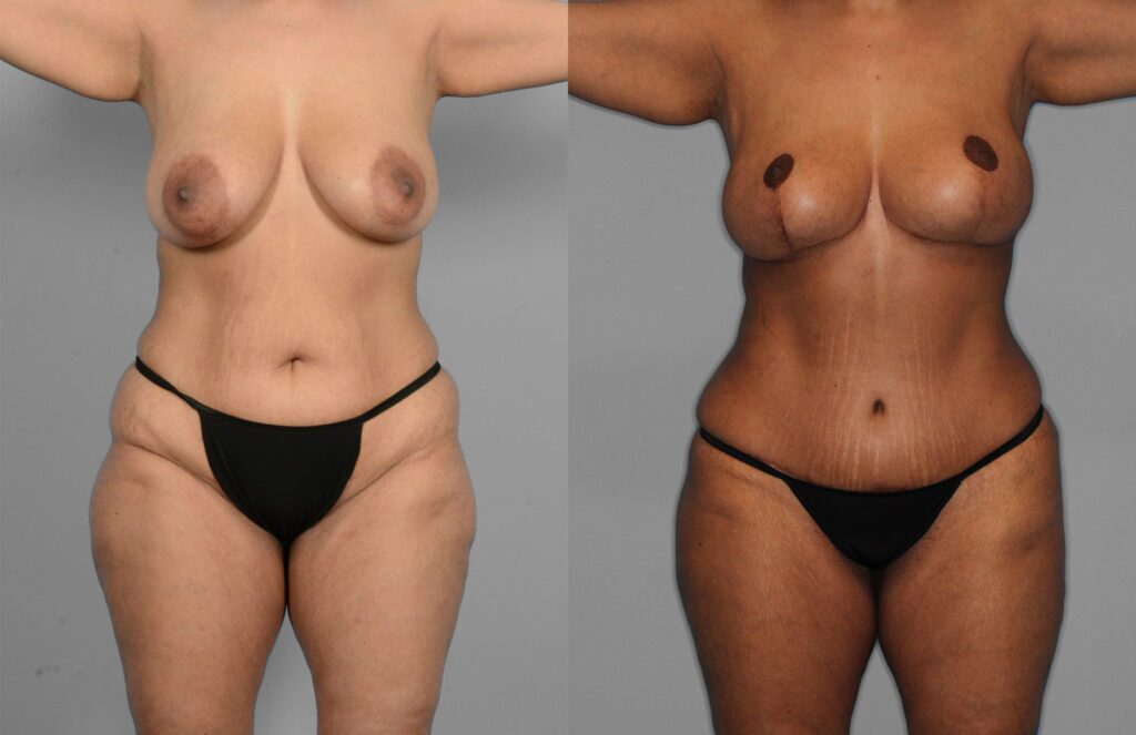 Tummy Tuck Before and After photo by Dr. Abigail Rodriguez in Houston, TX
