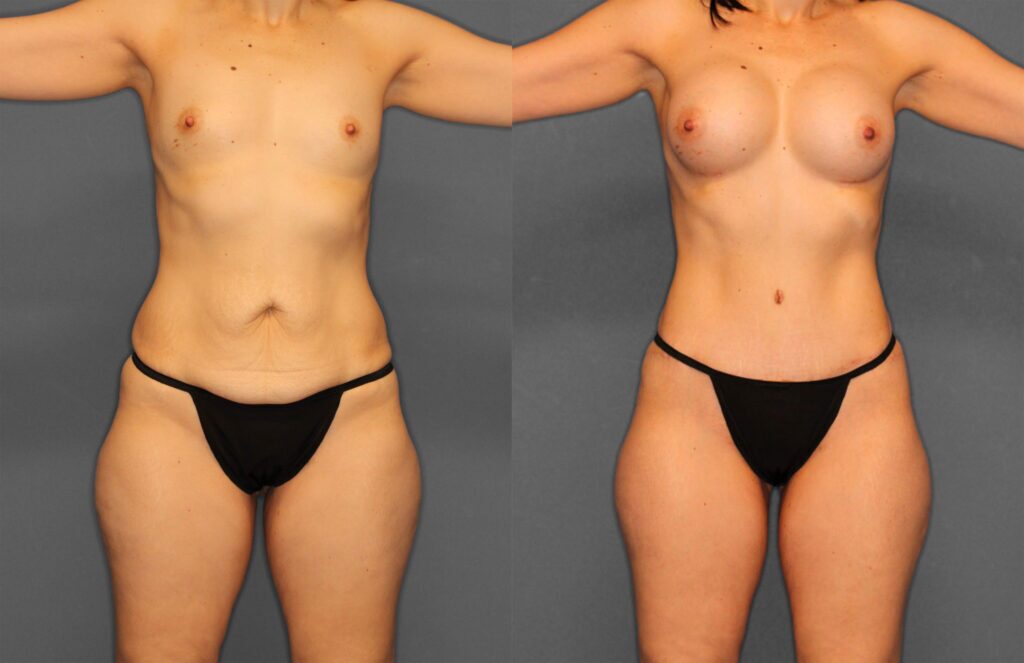 Tummy Tuck Before and After photo by Dr. Abigail Rodriguez in Houston, TX