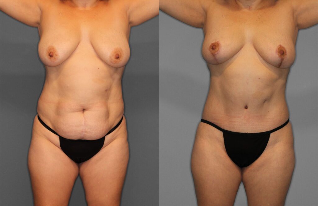 Tummy Tuck Before and After photo by Dr. Abigail Rodriguez in Houston, TX