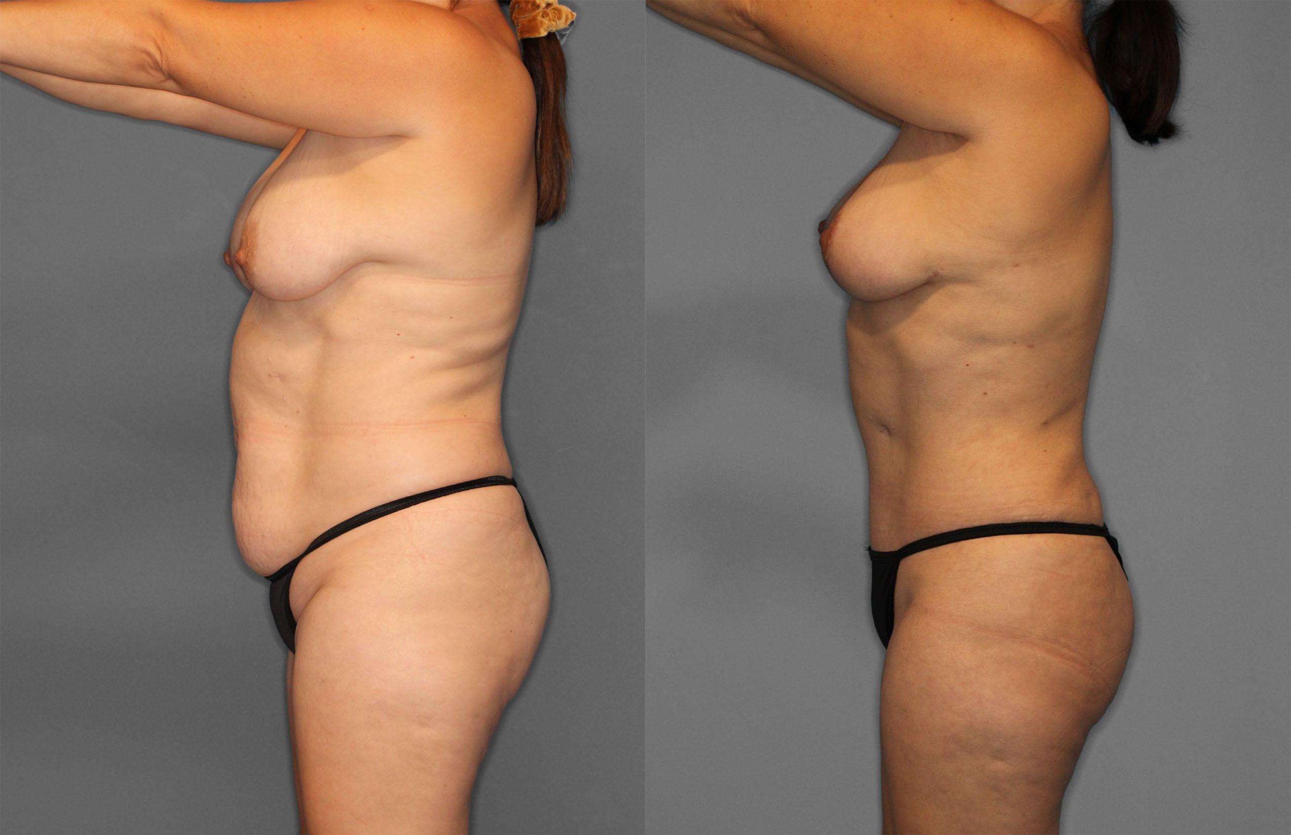 Tummy Tuck Before and After photo by Dr. Abigail Rodriguez in Houston, TX