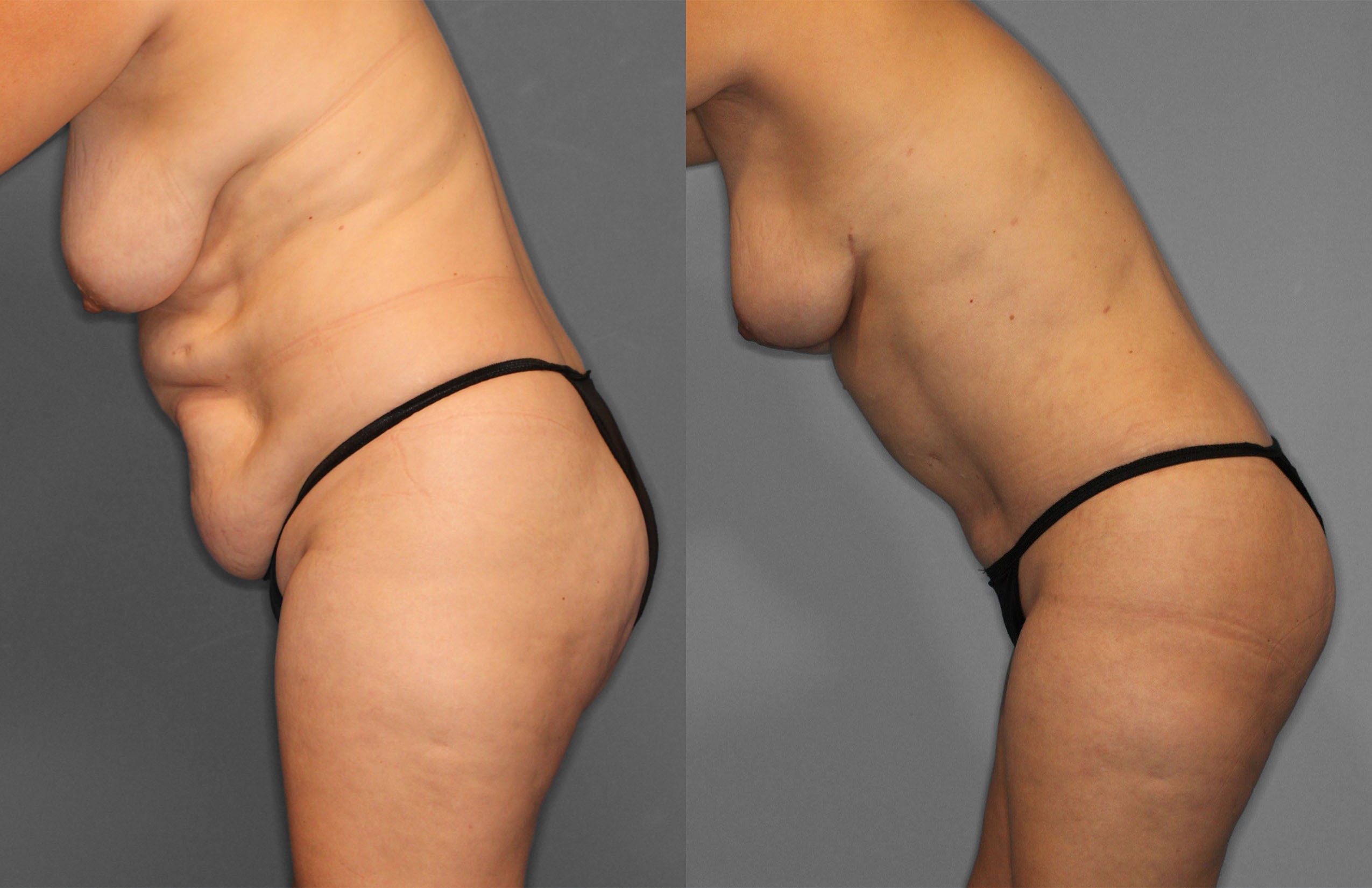 Tummy Tuck Before and After photo by Dr. Abigail Rodriguez in Houston, TX