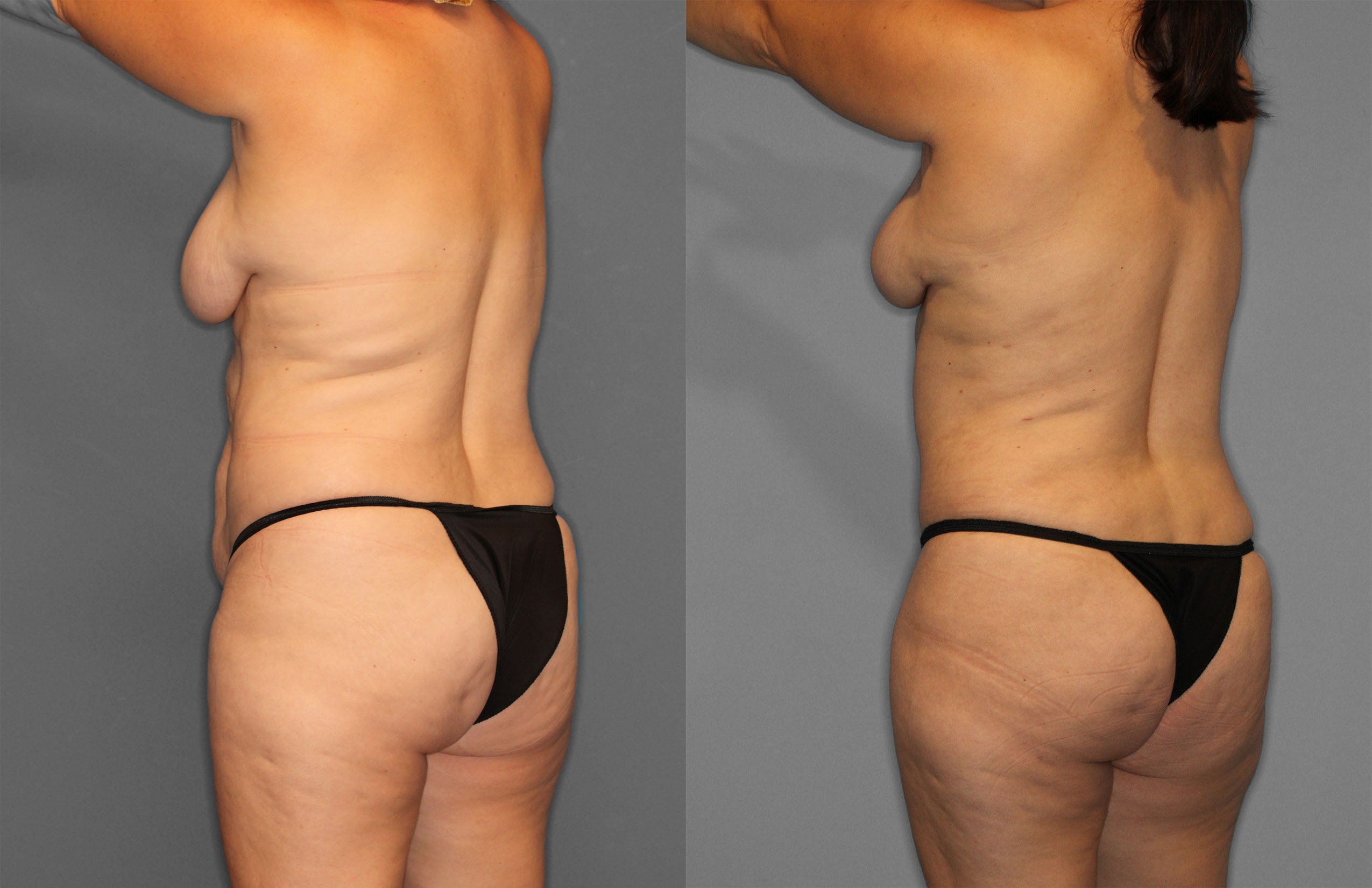 Tummy Tuck Before and After photo by Dr. Abigail Rodriguez in Houston, TX