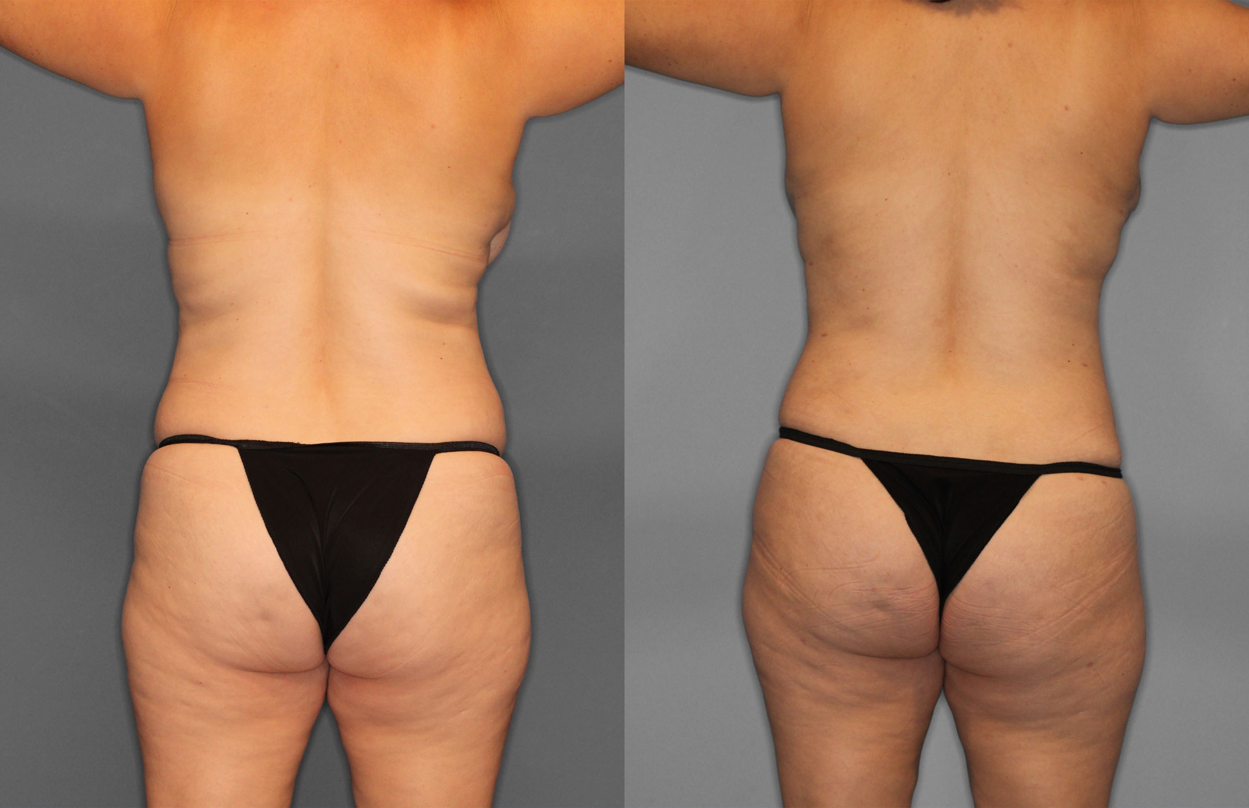 Tummy Tuck Before and After photo by Dr. Abigail Rodriguez in Houston, TX