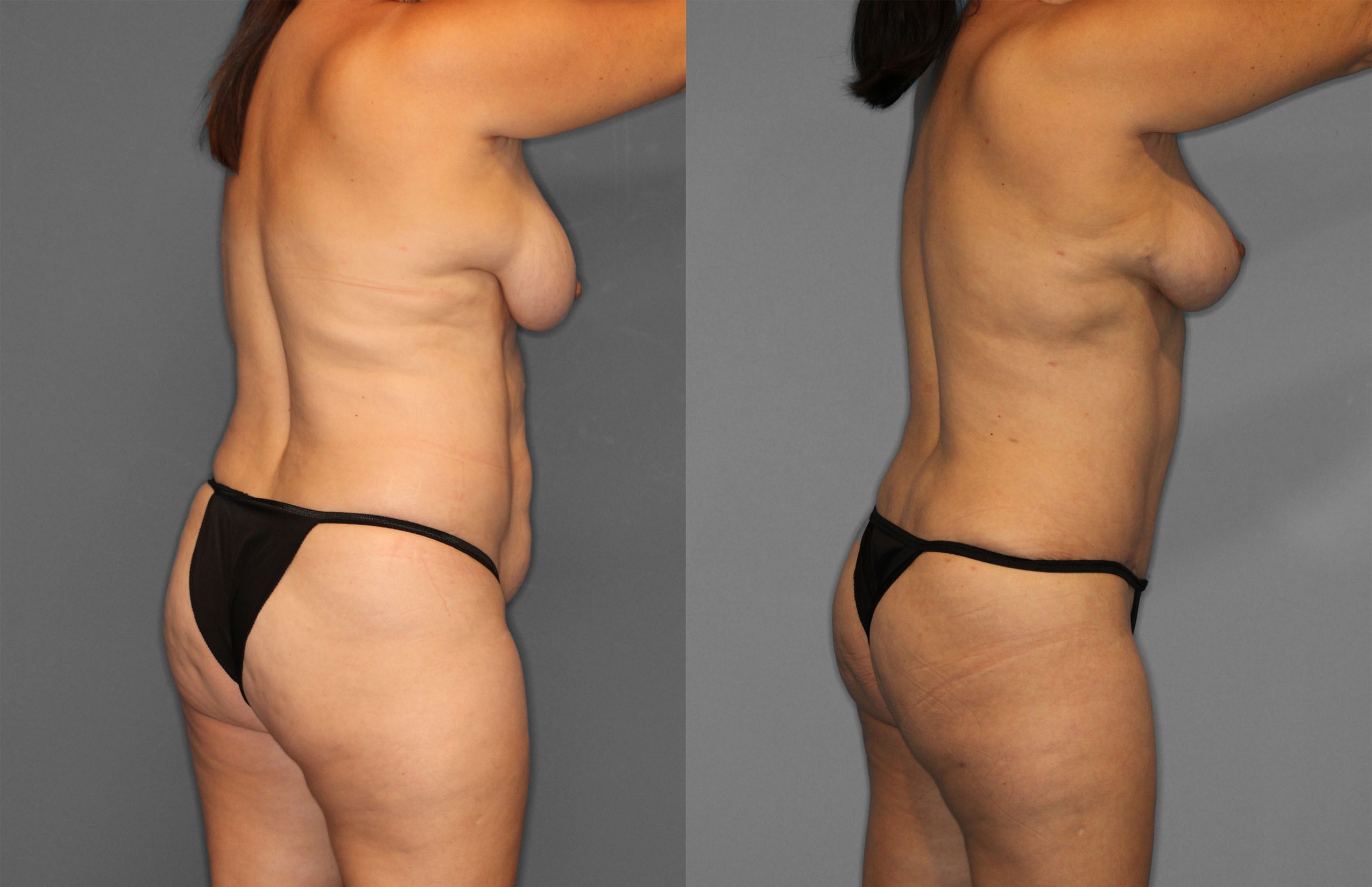 Tummy Tuck Before and After photo by Dr. Abigail Rodriguez in Houston, TX