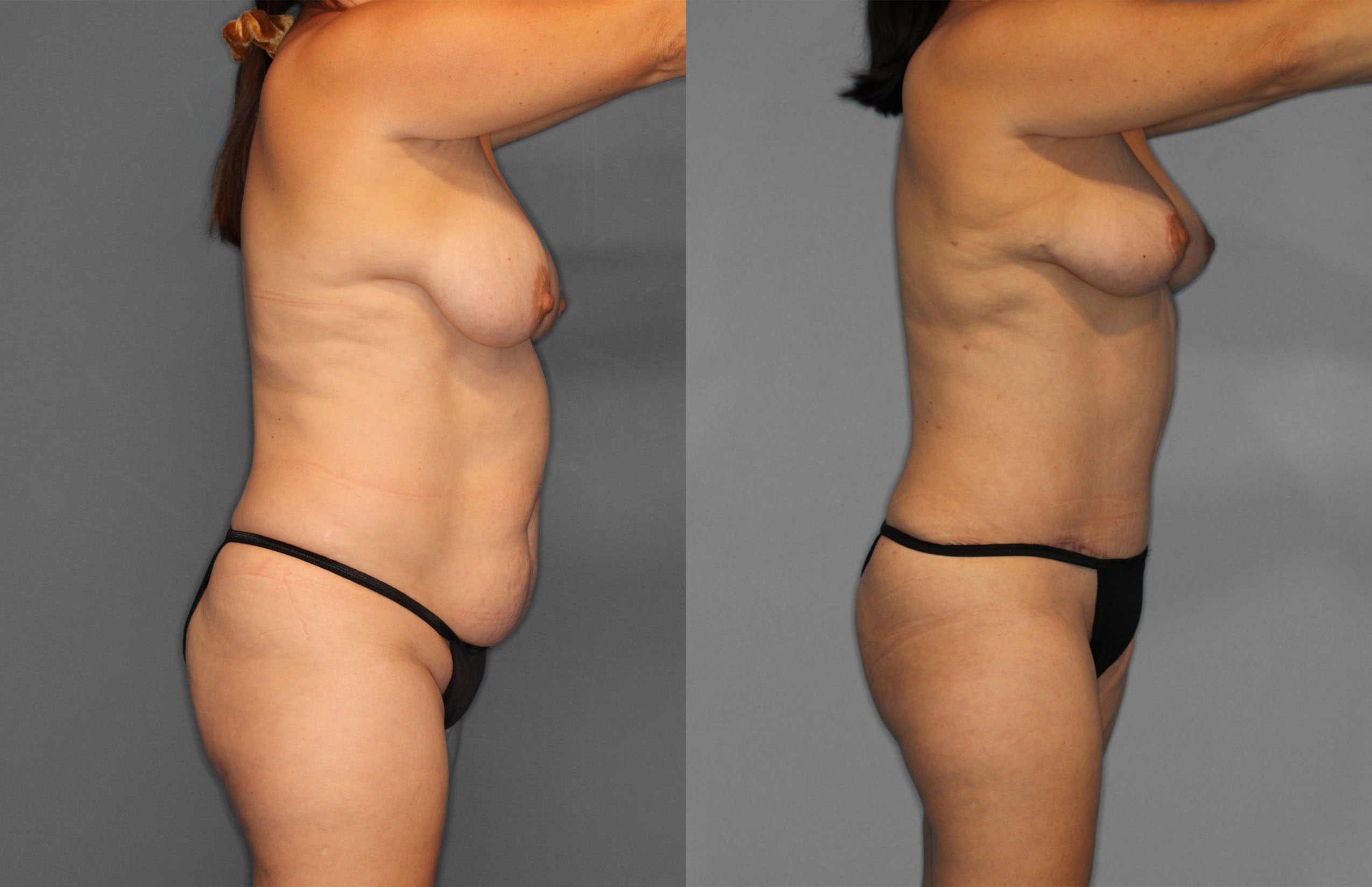 Tummy Tuck Before and After photo by Dr. Abigail Rodriguez in Houston, TX