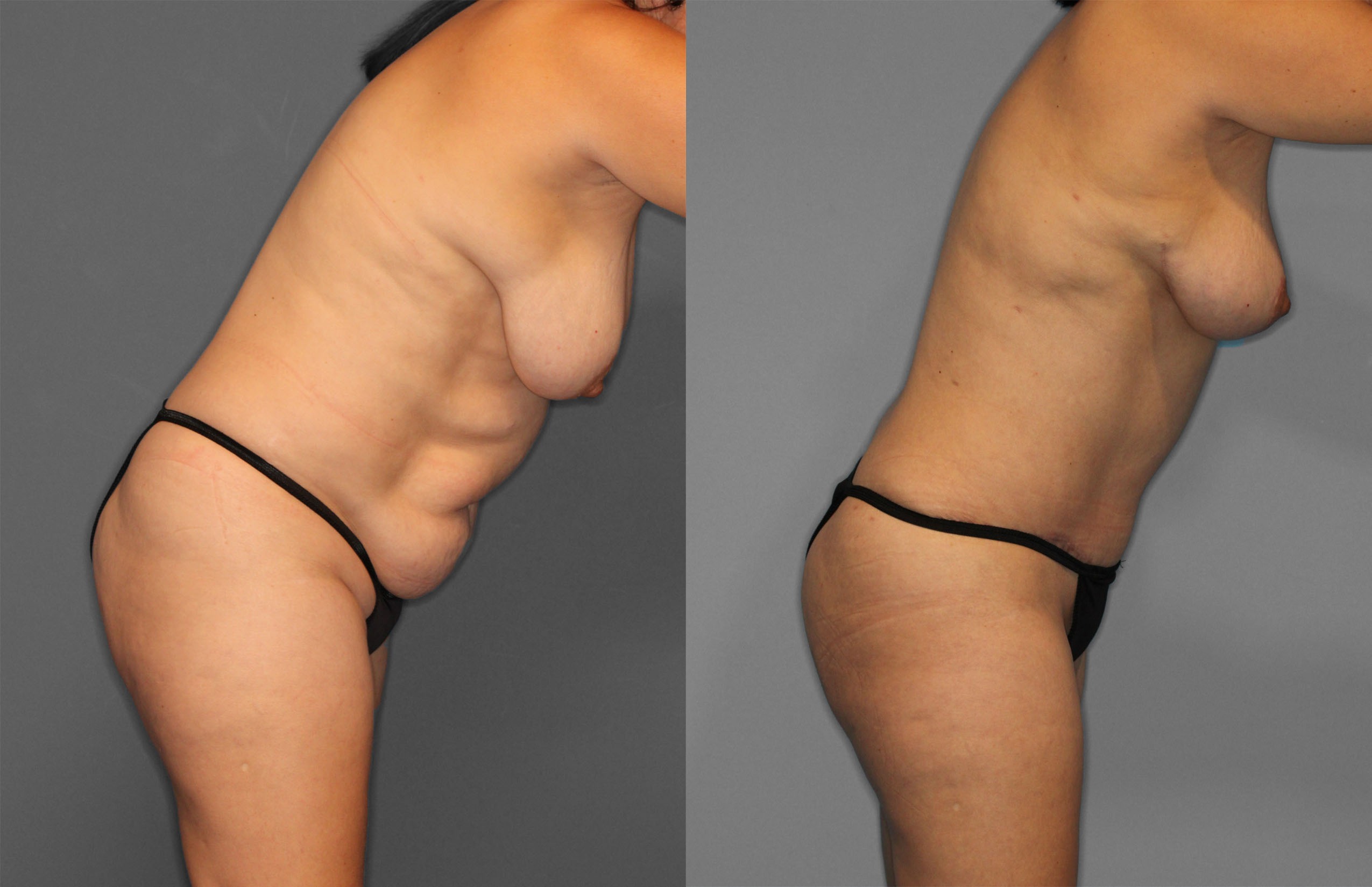 Tummy Tuck Before and After photo by Dr. Abigail Rodriguez in Houston, TX