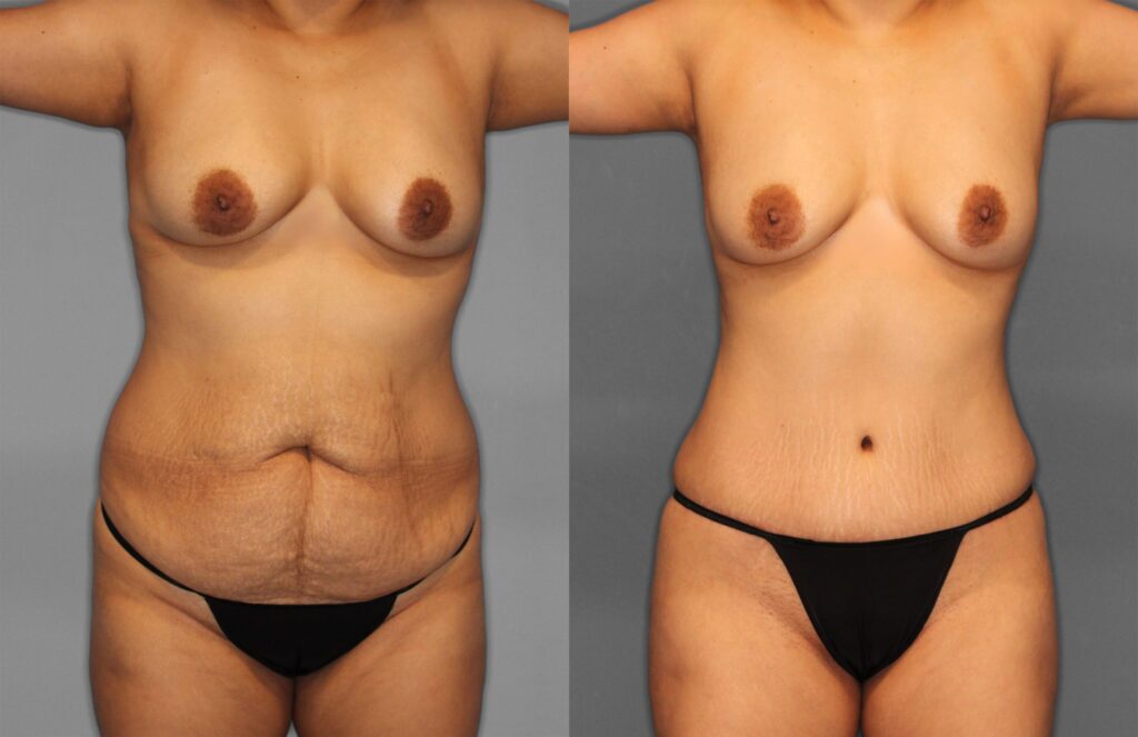 Tummy Tuck & Fat Grafting Before and After photo by Dr. Abigail Rodriguez in Houston, TX