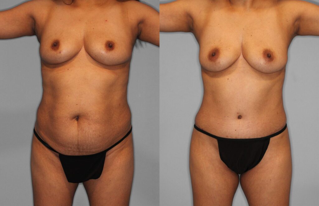 Tummy Tuck and Fat Grafting Before and After photo by Dr. Abigail Rodriguez in Houston, TX
