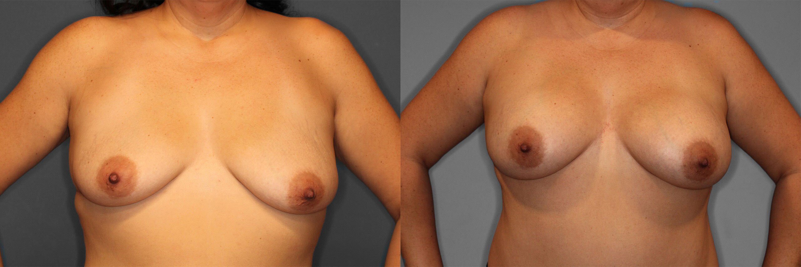 Breast Augmentation Before and After photo by Dr. Abigail Rodriguez in Houston, TX