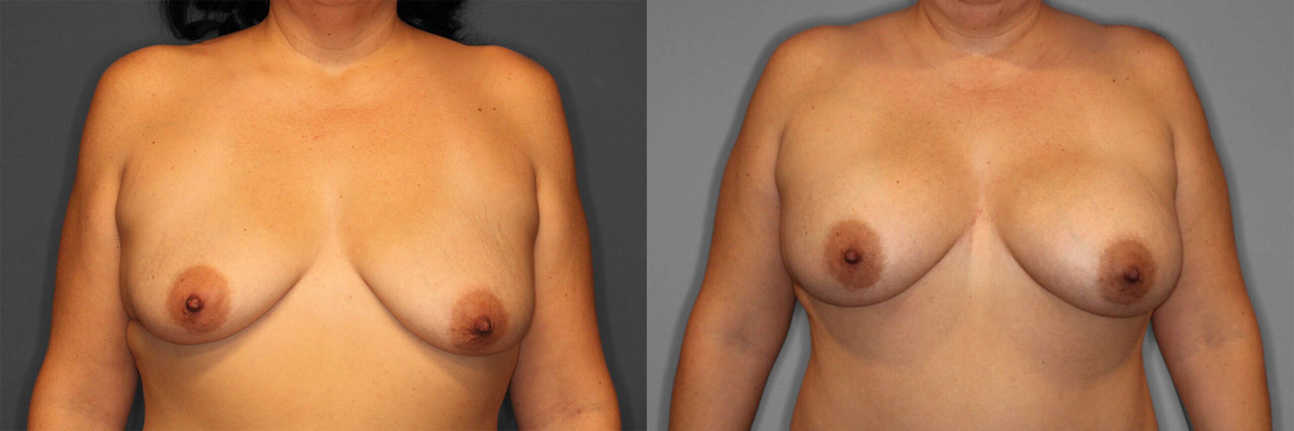 Breast Augmentation Before and After photo by Dr. Abigail Rodriguez in Houston, TX