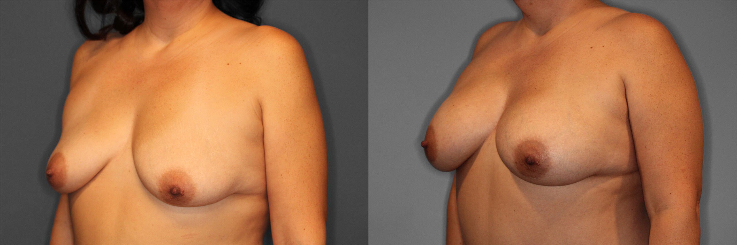 Breast Augmentation Before and After photo by Dr. Abigail Rodriguez in Houston, TX
