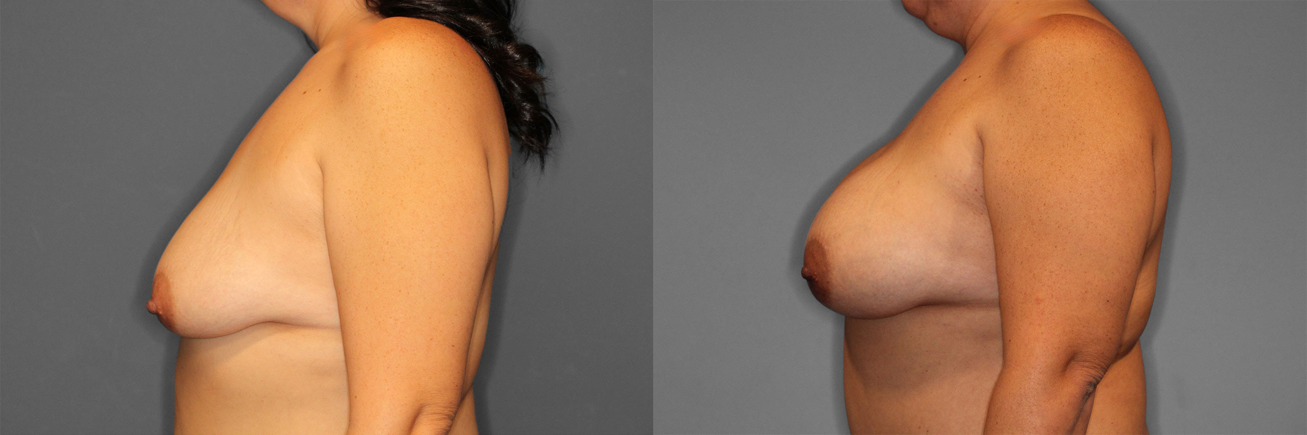 Breast Augmentation Before and After photo by Dr. Abigail Rodriguez in Houston, TX