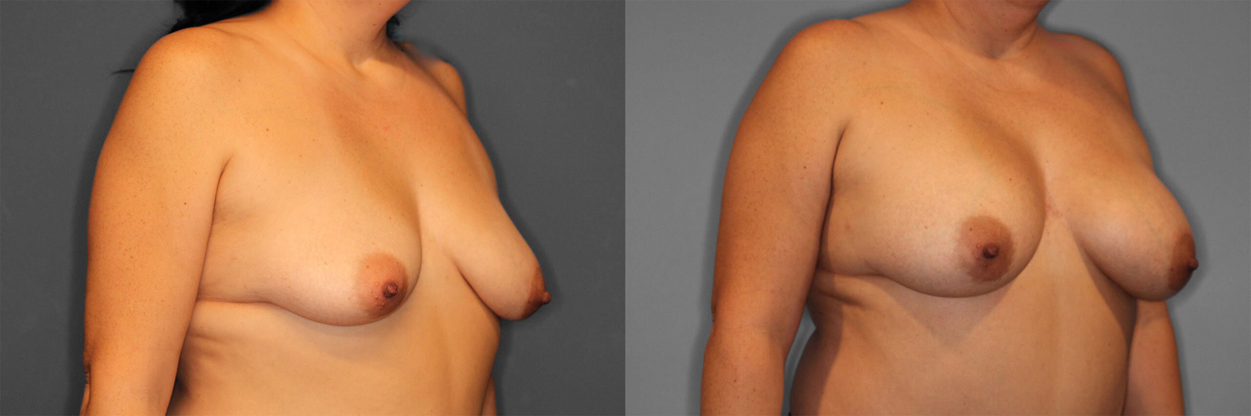 Breast Augmentation Before and After photo by Dr. Abigail Rodriguez in Houston, TX