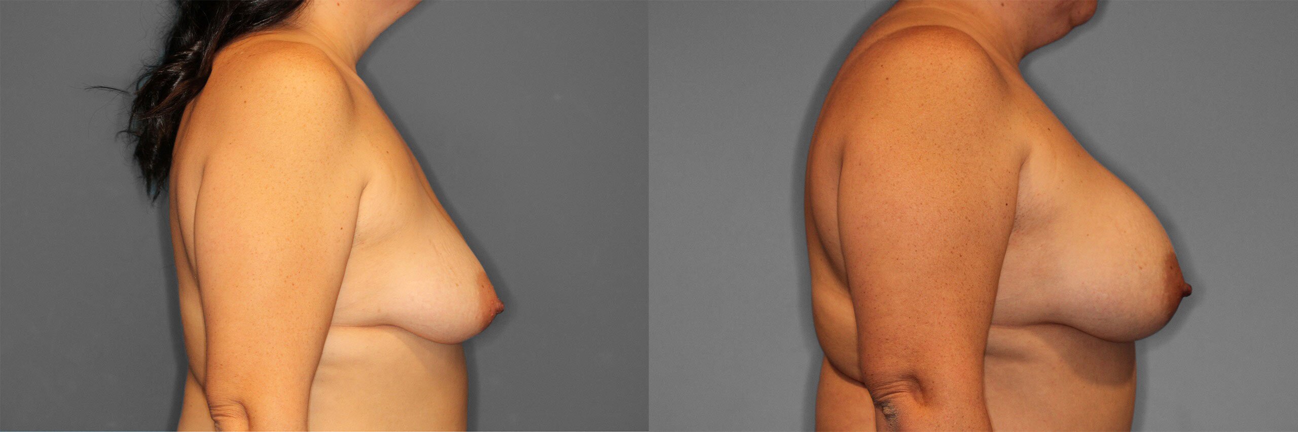 Breast Augmentation Before and After photo by Dr. Abigail Rodriguez in Houston, TX