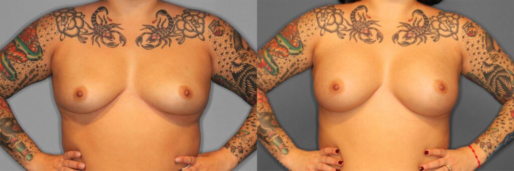 Breast Augmentation Before and After photo by Dr. Abigail Rodriguez in Houston, TX