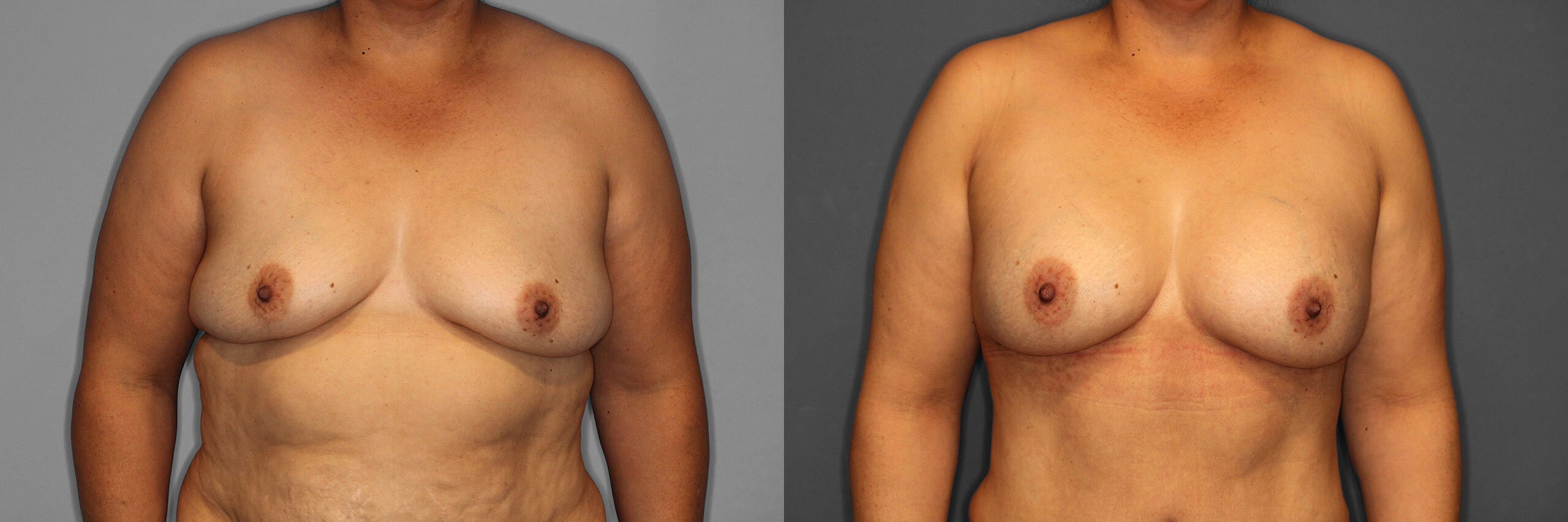 Breast Augmentation Before and After photo by Dr. Abigail Rodriguez in Houston, TX