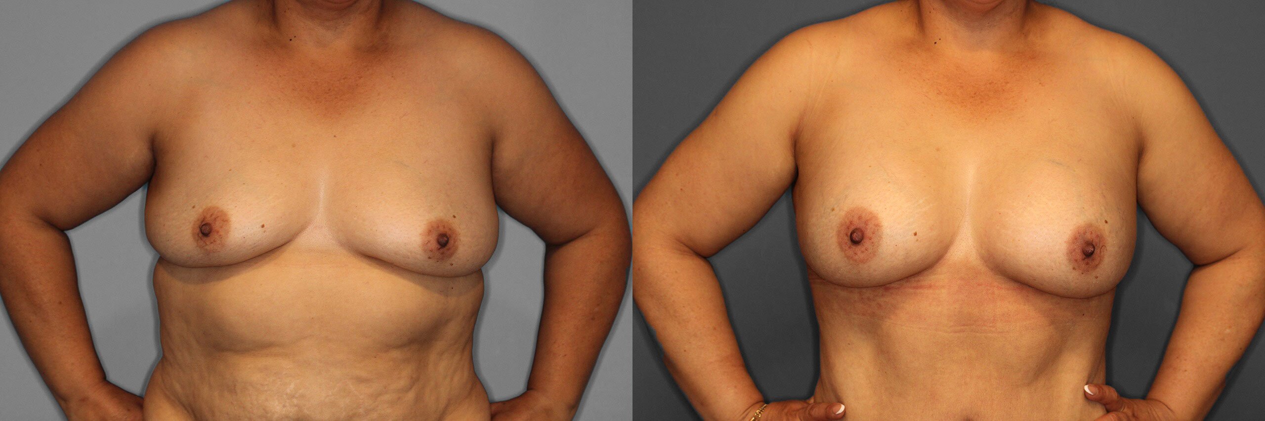Breast Augmentation Before and After photo by Dr. Abigail Rodriguez in Houston, TX