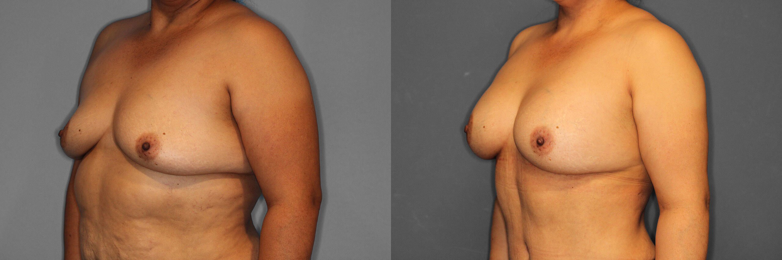Breast Augmentation Before and After photo by Dr. Abigail Rodriguez in Houston, TX