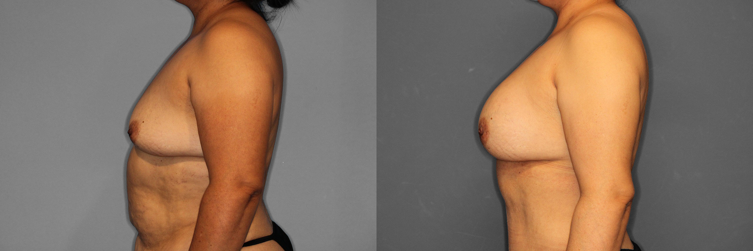 Breast Augmentation Before and After photo by Dr. Abigail Rodriguez in Houston, TX