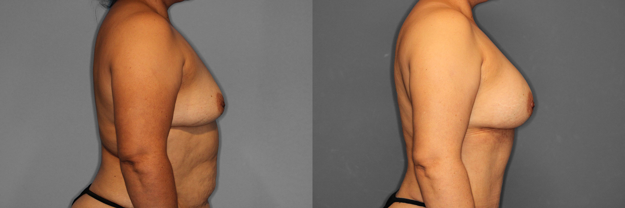 Breast Augmentation Before and After photo by Dr. Abigail Rodriguez in Houston, TX