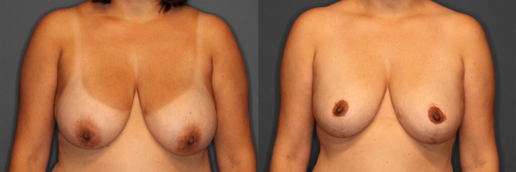 Breast Reduction Before and After photo by Dr. Abigail Rodriguez in Houston, TX