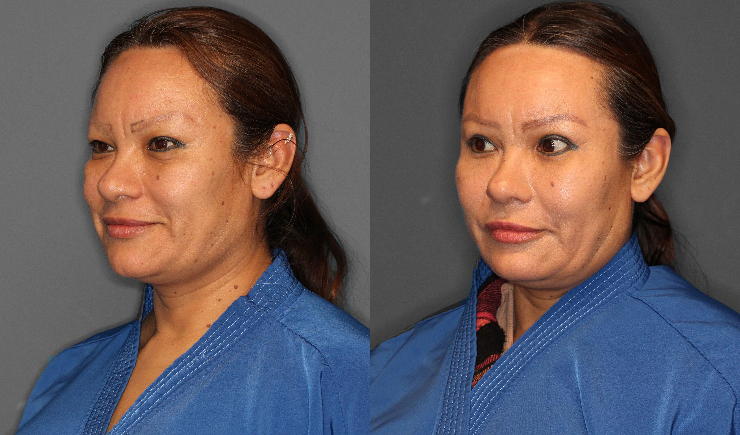 Eyelid Lift Before and After photo by Dr. Abigail Rodriguez in Houston, TX