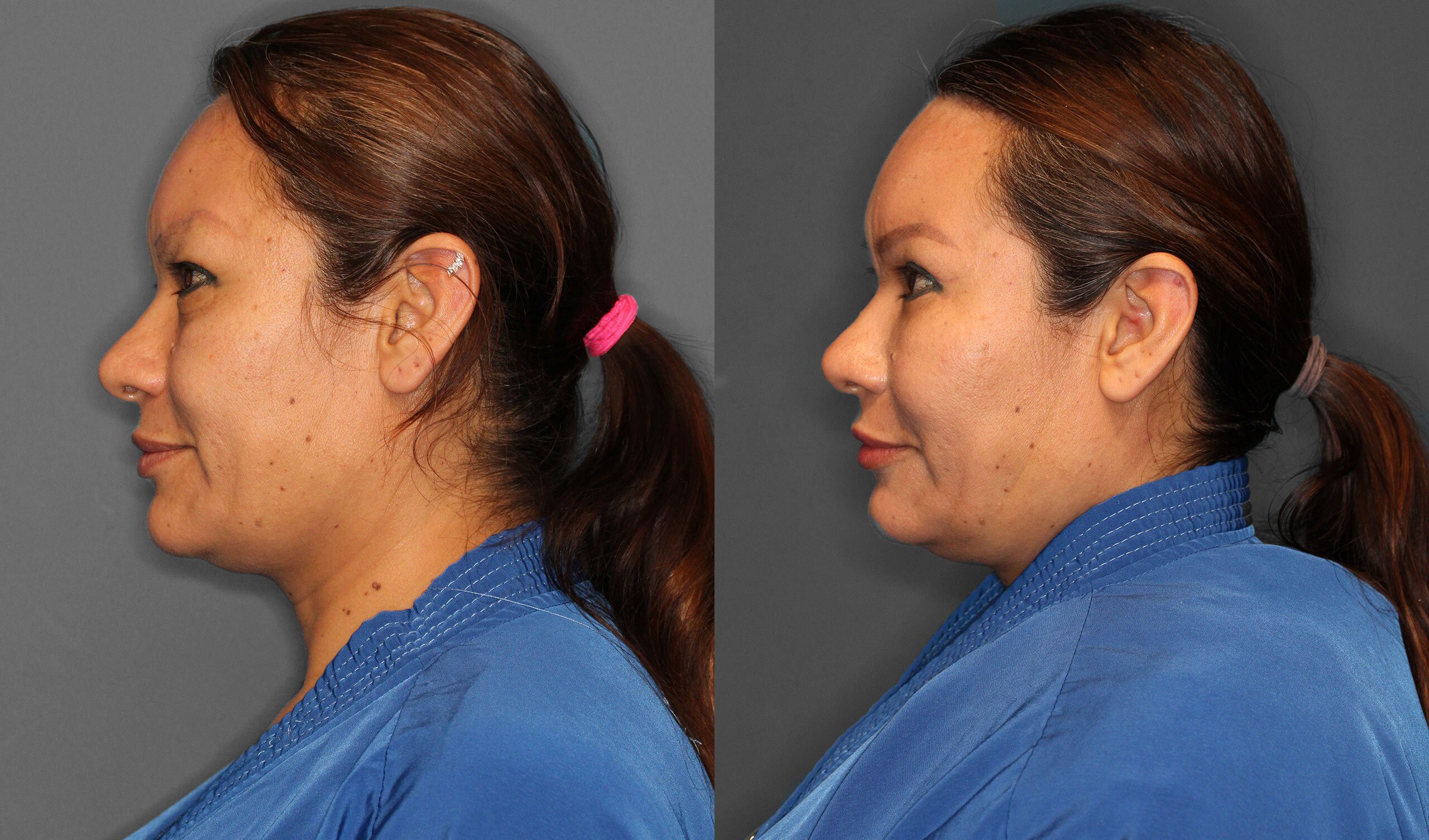 Eyelid Lift Before and After photo by Dr. Abigail Rodriguez in Houston, TX