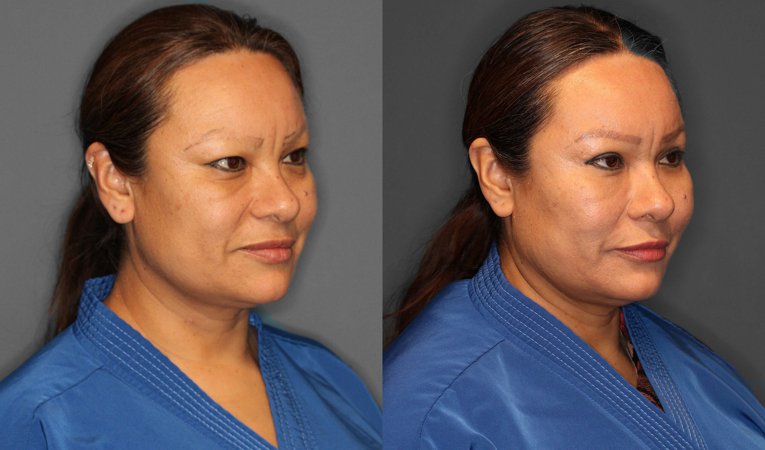 Eyelid Lift Before and After photo by Dr. Abigail Rodriguez in Houston, TX