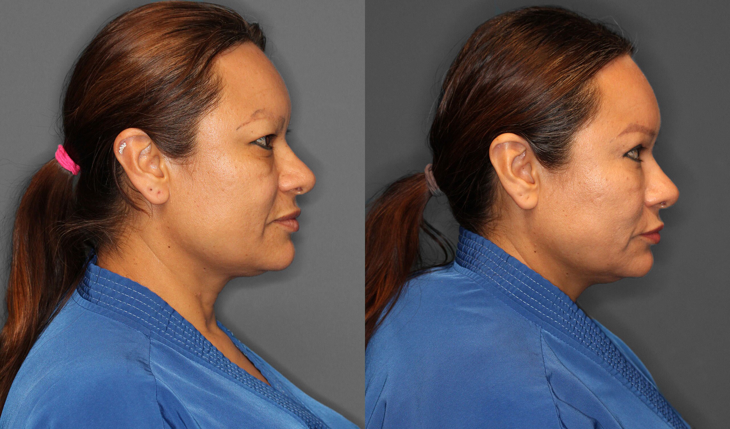 Eyelid Lift Before and After photo by Dr. Abigail Rodriguez in Houston, TX