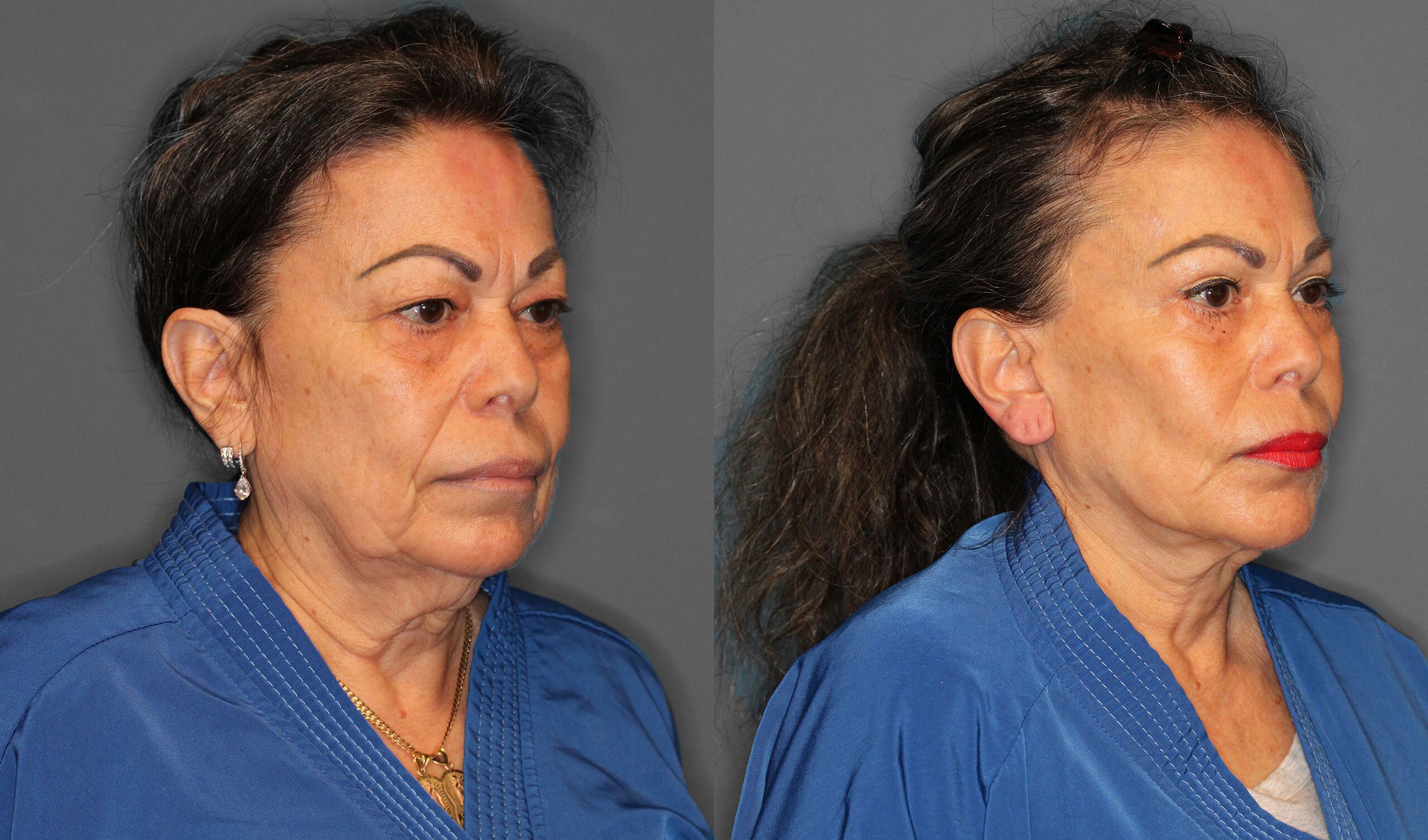 Face Neck Lift Eyelid Lift Fat Grafting Before and After photo by Dr. Abigail Rodriguez in Houston, TX