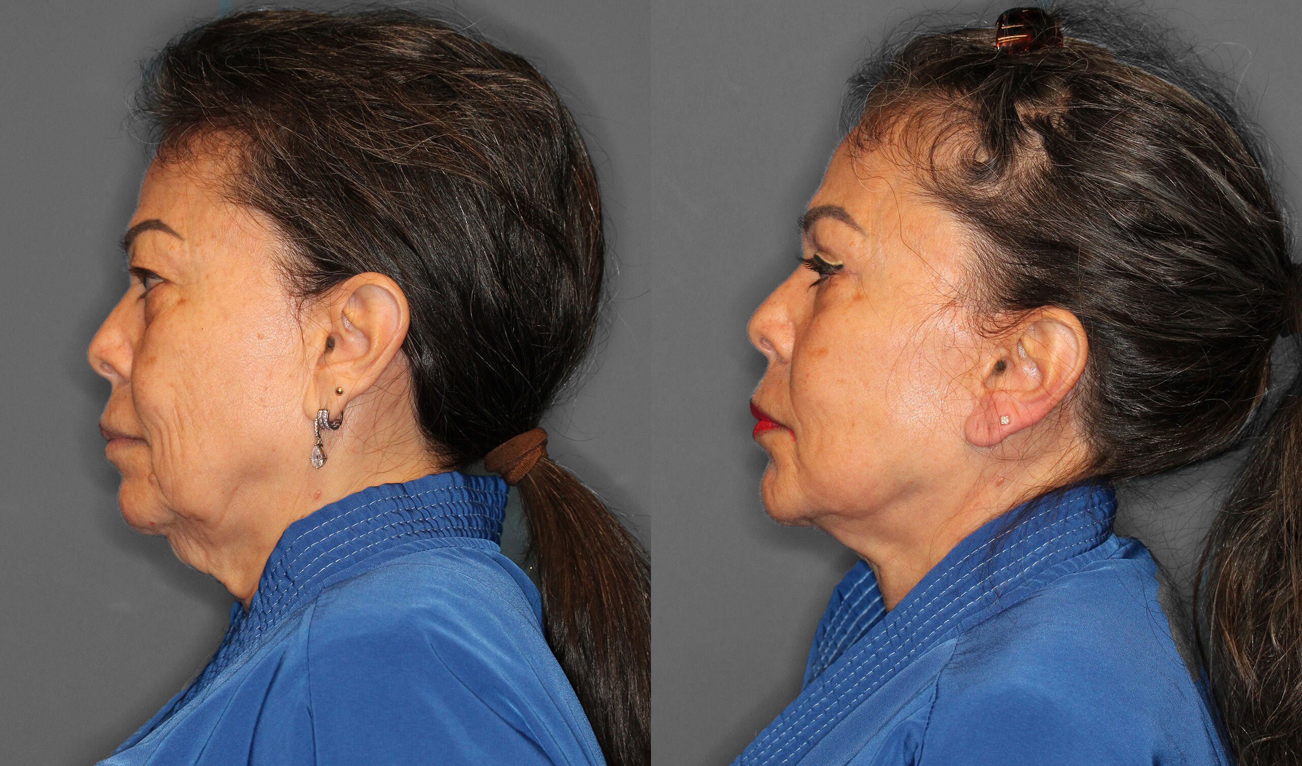 Face Neck Lift Eyelid Lift Fat Grafting Before and After photo by Dr. Abigail Rodriguez in Houston, TX