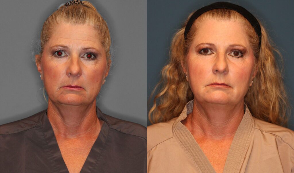 Facial Fat Grafting Before and After photo by Dr. Abigail Rodriguez in Houston, TX
