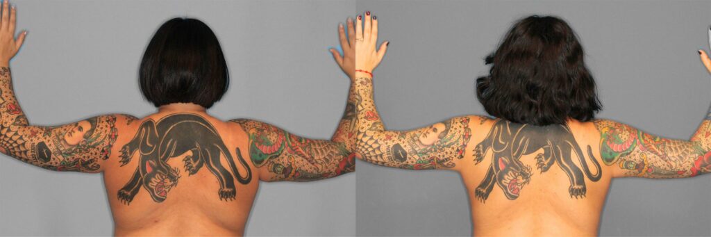 Liposuction Before and After photo by Dr. Abigail Rodriguez in Houston, TX