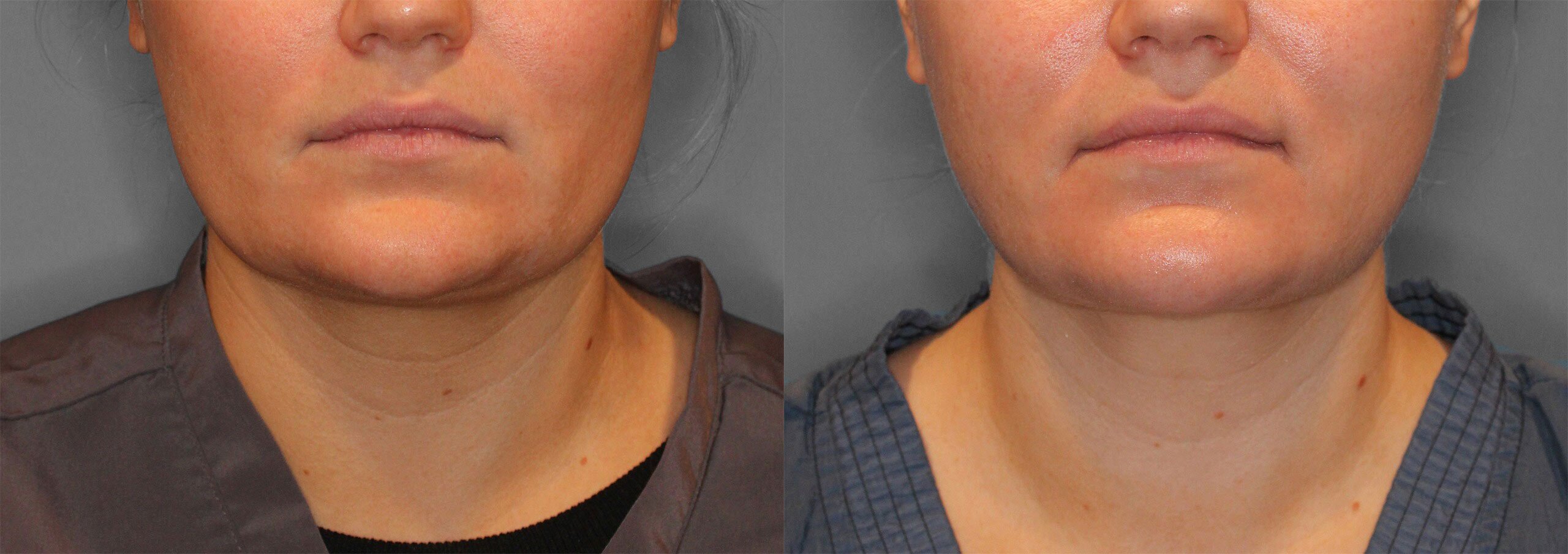 Neck Liposuction Before and After photo by Dr. Abigail Rodriguez in Houston, TX