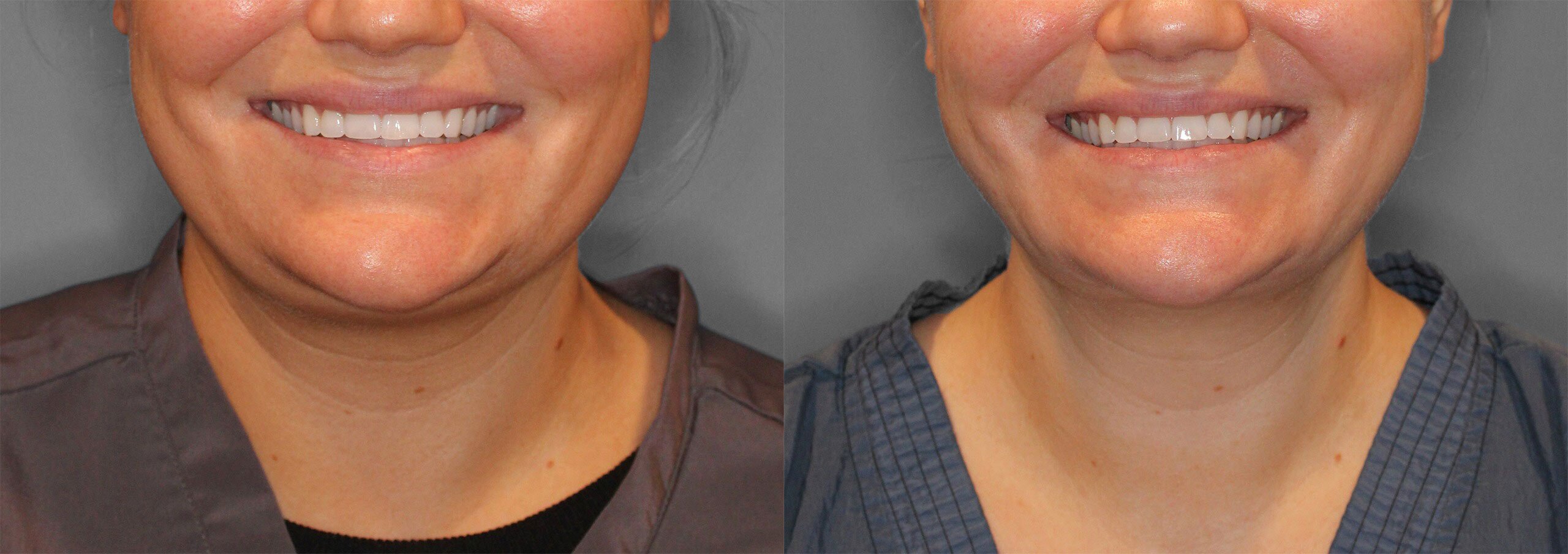 Neck Liposuction Before and After photo by Dr. Abigail Rodriguez in Houston, TX