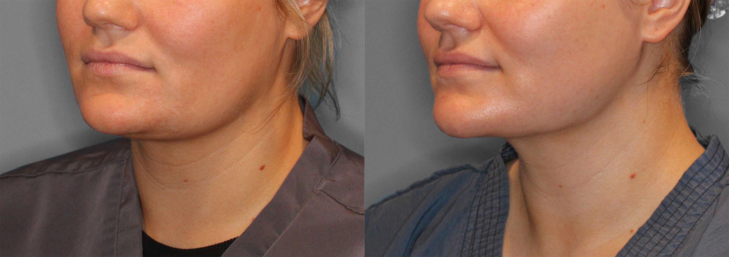 Neck Liposuction Before and After photo by Dr. Abigail Rodriguez in Houston, TX