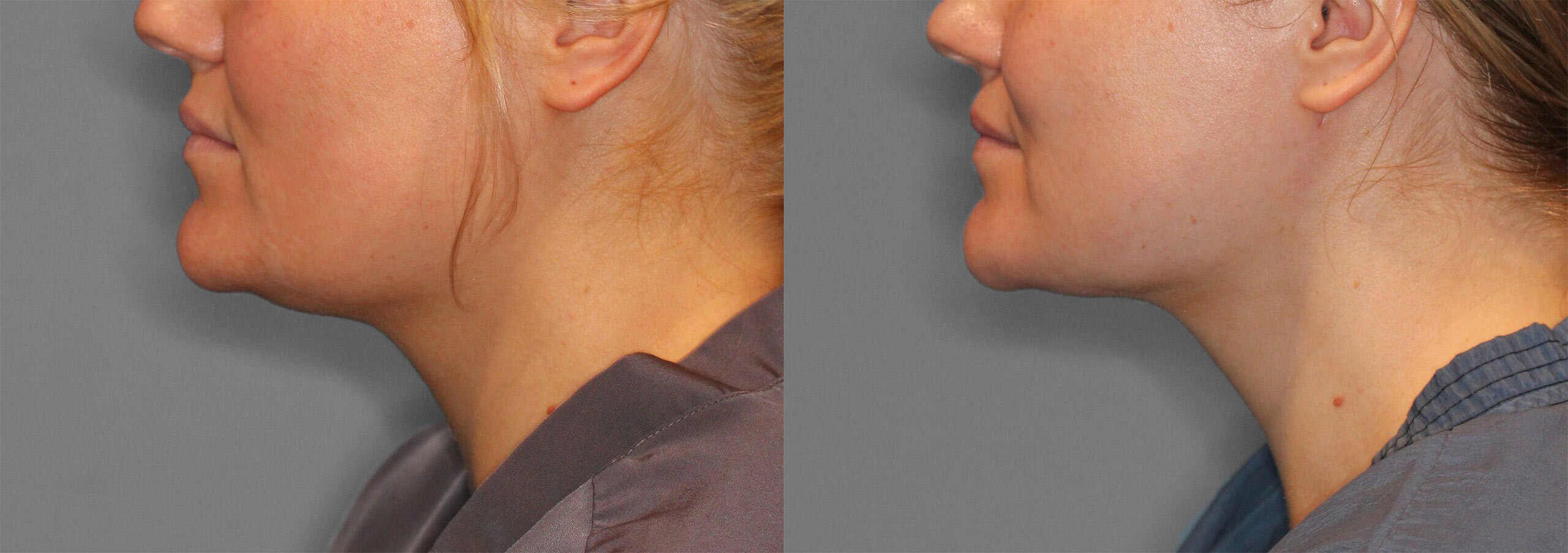 Neck Liposuction Before and After photo by Dr. Abigail Rodriguez in Houston, TX