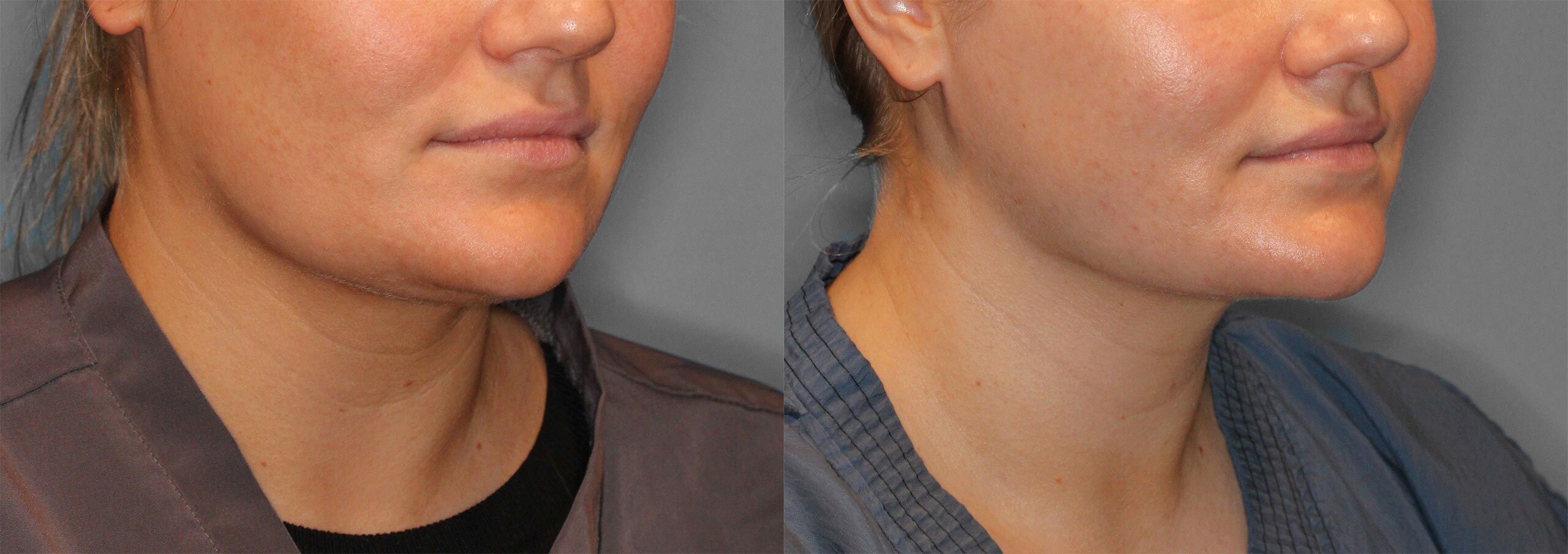 Neck Liposuction Before and After photo by Dr. Abigail Rodriguez in Houston, TX
