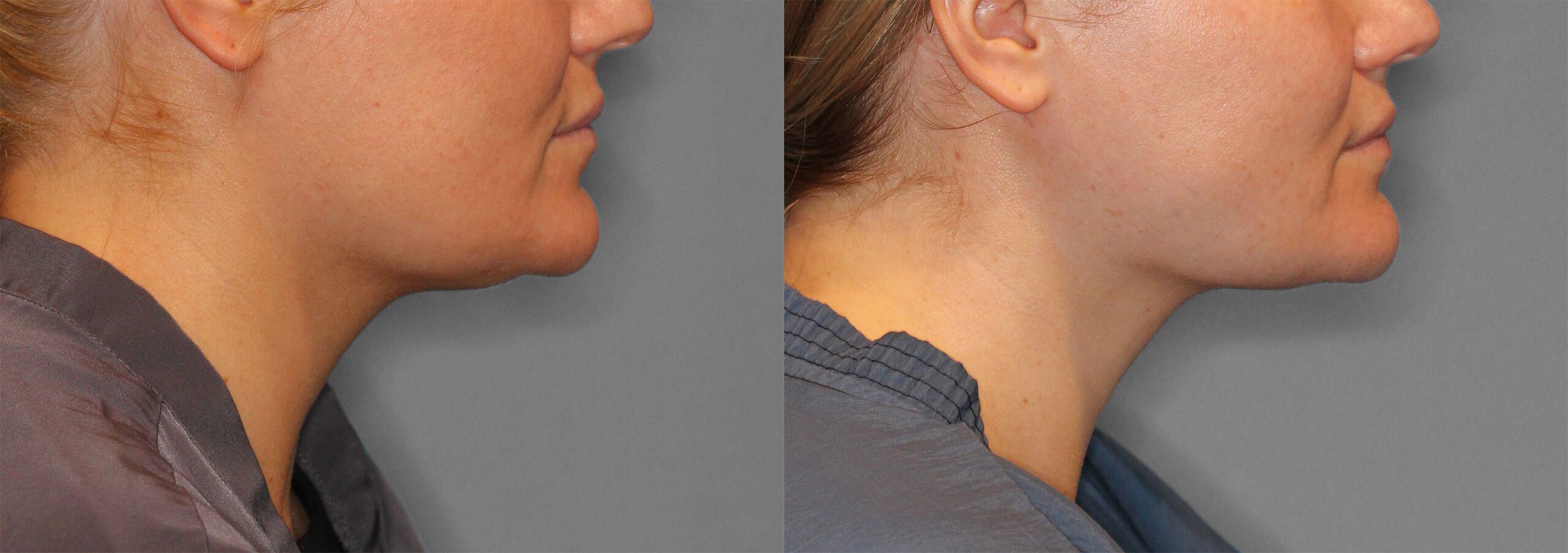 Neck Liposuction Before and After photo by Dr. Abigail Rodriguez in Houston, TX