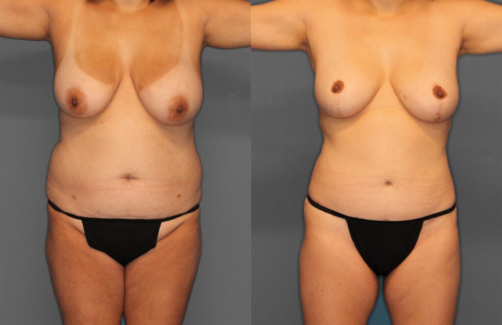 Tummy Tuck Before and After photo by Dr. Abigail Rodriguez in Houston, TX